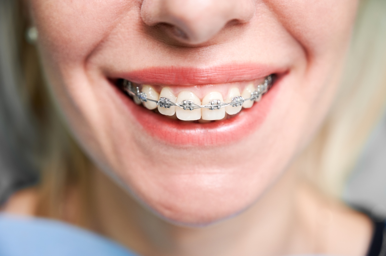 Our braces: Dynaflex Norris Passive Self-Ligating Bracket System