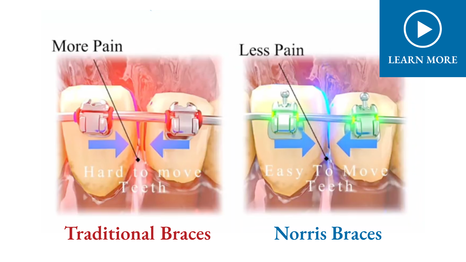 Norris Braces illustration comparing traditional braces and Norris passive self-ligating brackets for easier tooth movement